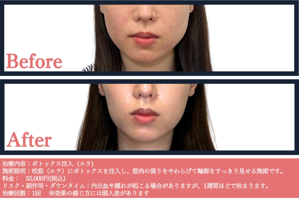 ボトックス注射の症例写真とビフォー&アフター