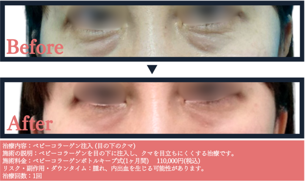 黒クマの凹みにヒアルロン酸注入症例写真とビフォー&アフター