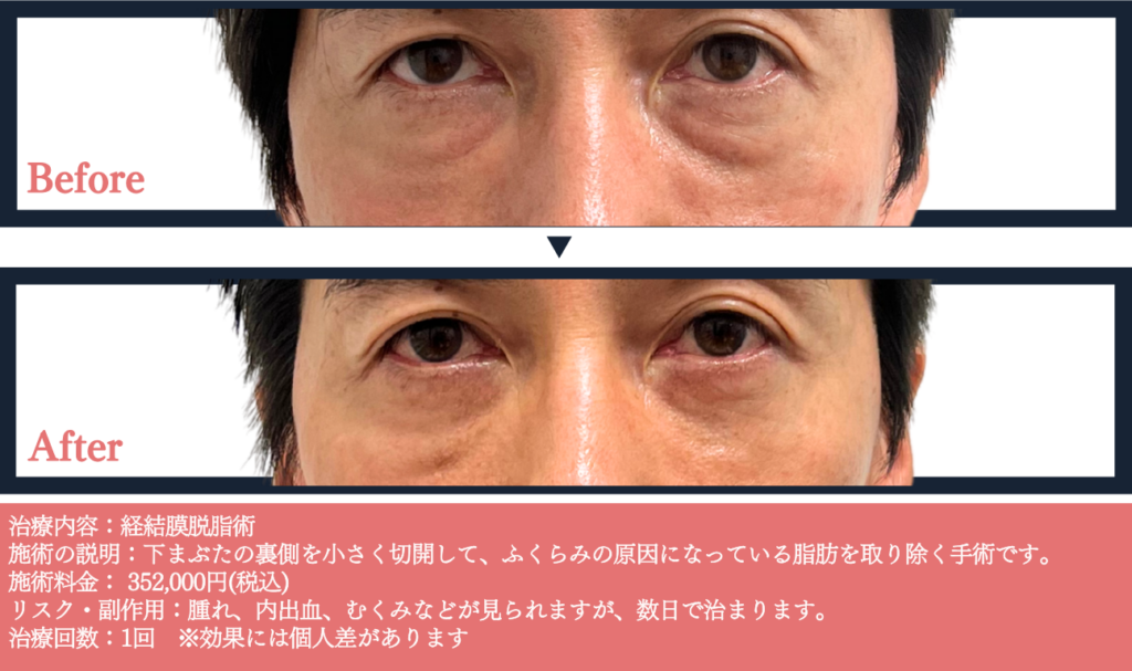 黒クマのたるみに経結膜脱脂症例写真とビフォー&アフター