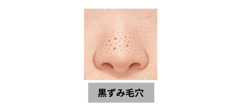 黒ずみ毛穴イメージ