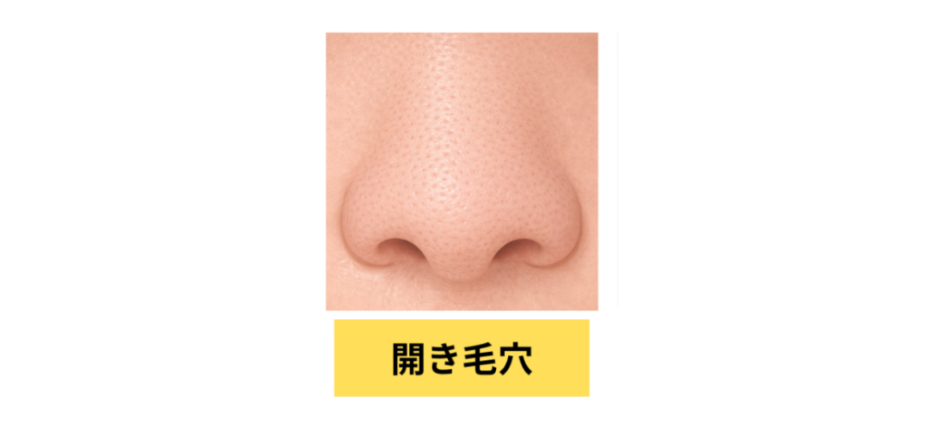 開き毛穴イメージ