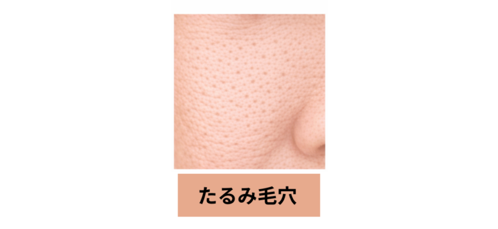 たるみ毛穴イメージ
