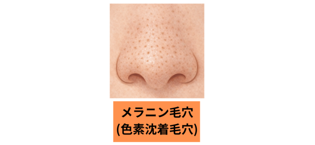 メラニン毛穴（色素沈着毛穴）イメージ