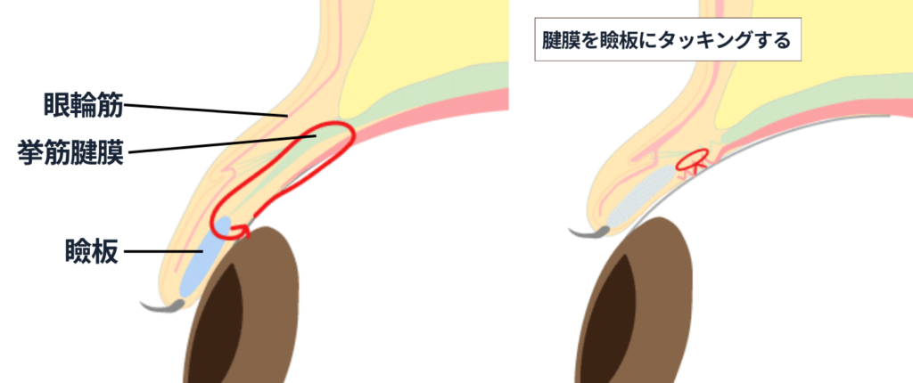 腱膜性の眼瞼下垂治療①タッキング手術