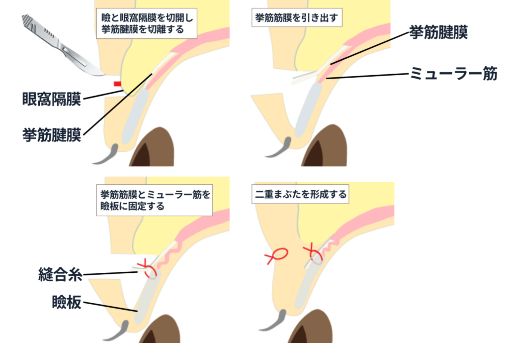 腱膜性の眼瞼下垂治療②重瞼線切開による挙筋前転術