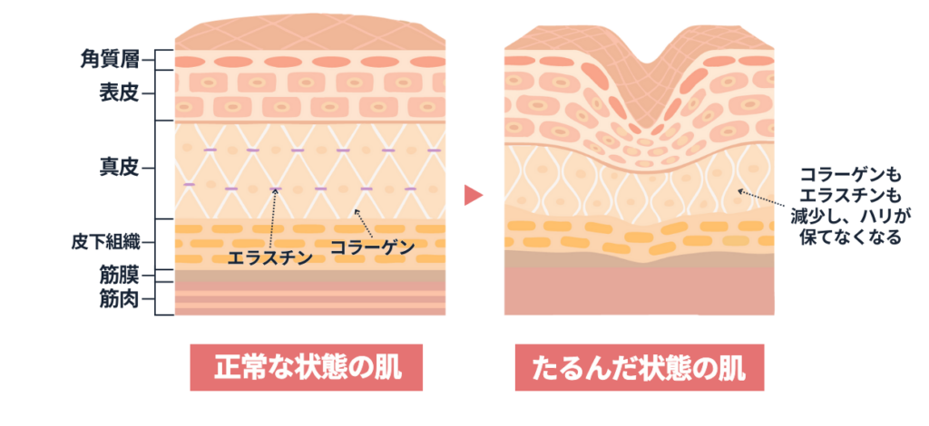 コラーゲンとエラスチンの減少イメージ