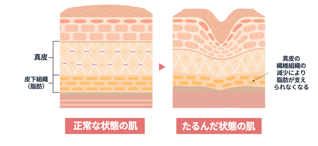 脂肪の下垂イメージ